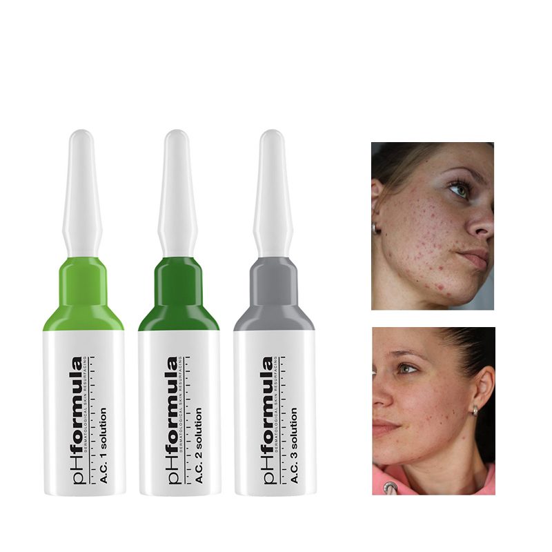 Acne treatment with Skin resurfacing