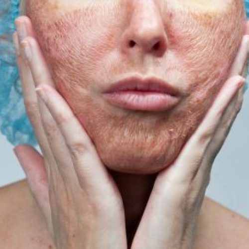 Skin Resurfacing vs Chemical Peel